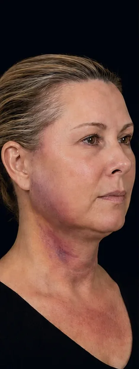 Illustrative early recovery appearance